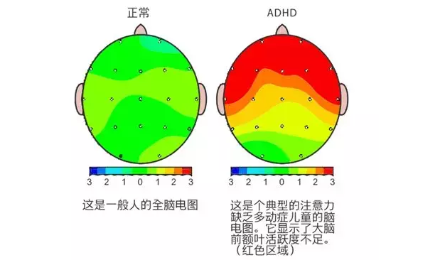 多动症患者和正常人脑电图对比