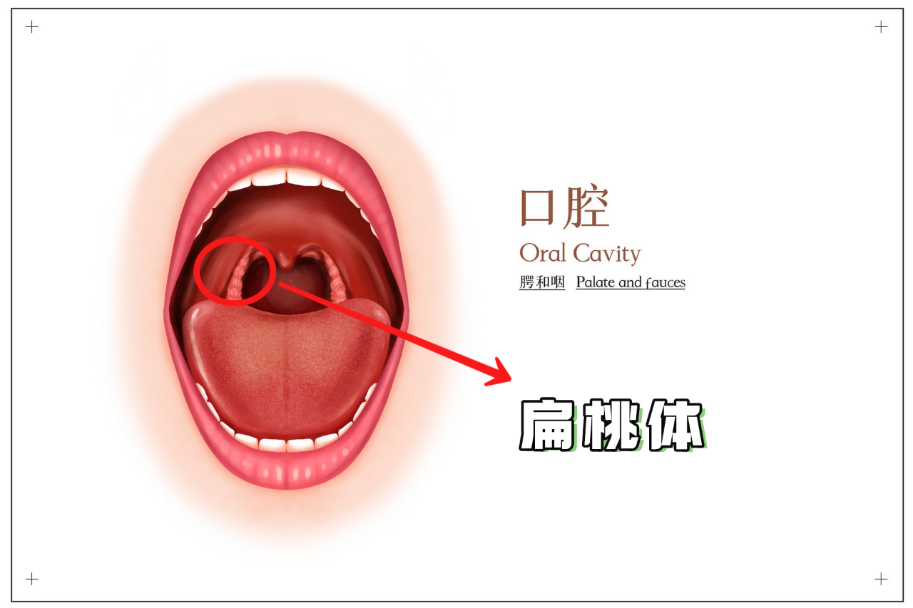 扁桃体反复发炎,肿大,孩子经常感冒,高烧不退!是割还是留?