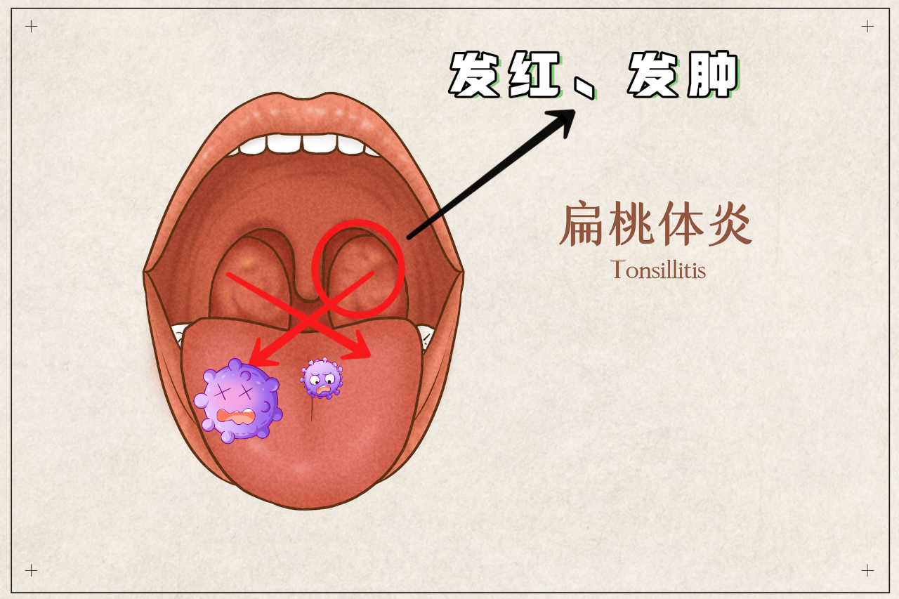 扁桃体发炎
