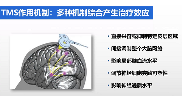 重复经颅磁的应用